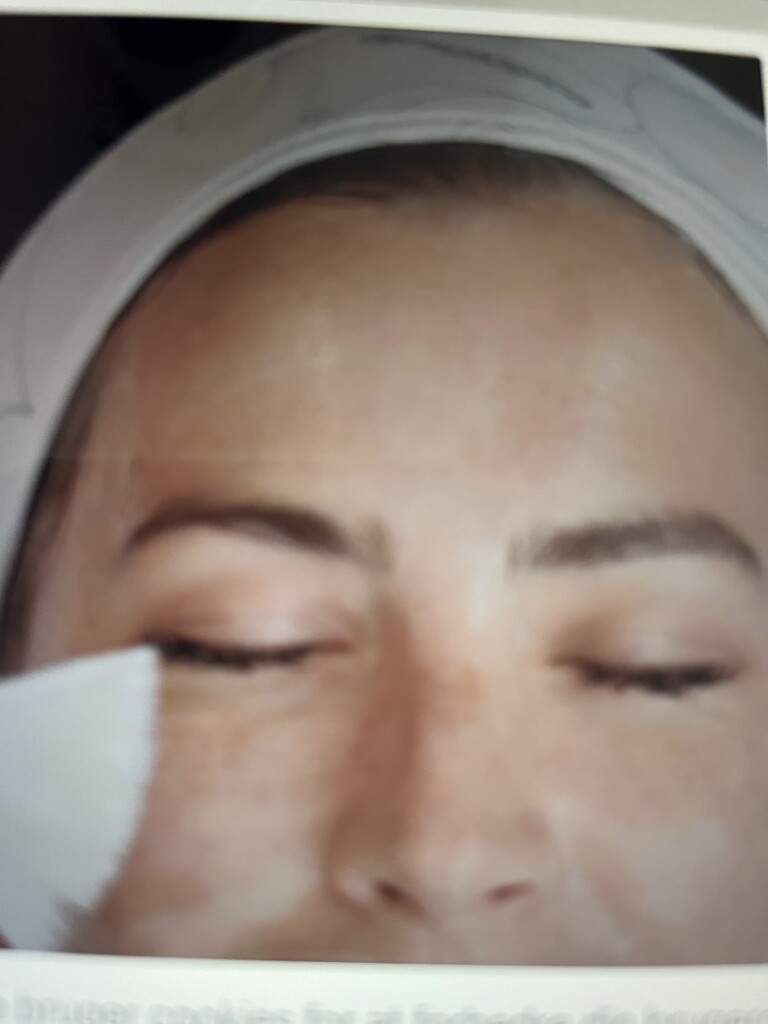 Hudpleje